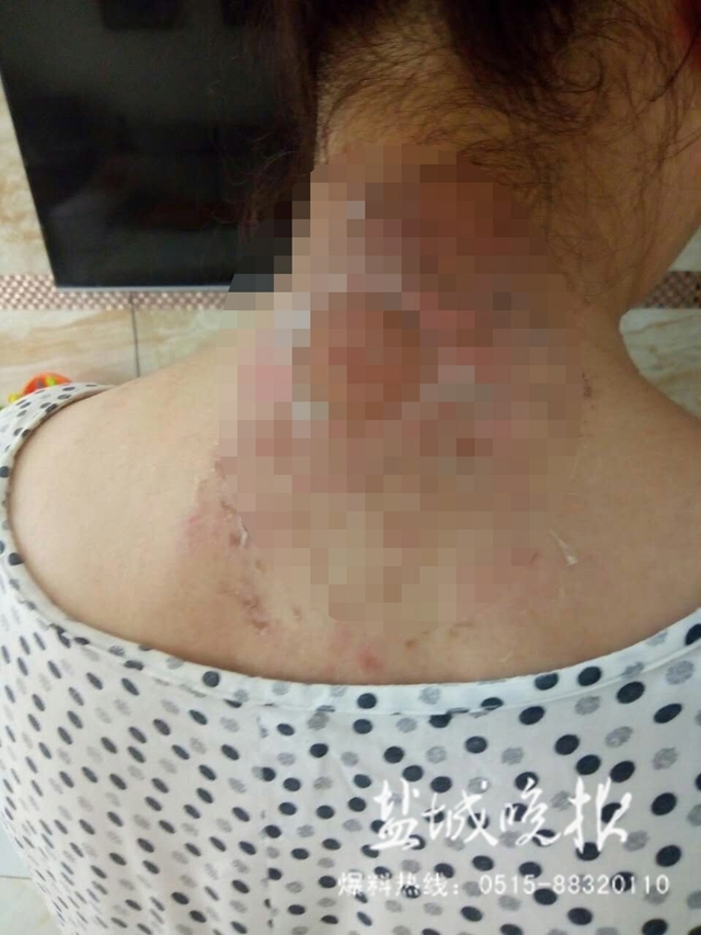 冬病夏治三伏贴,盐城老人贴出大水泡—— 治病贴膏药需去正规医院