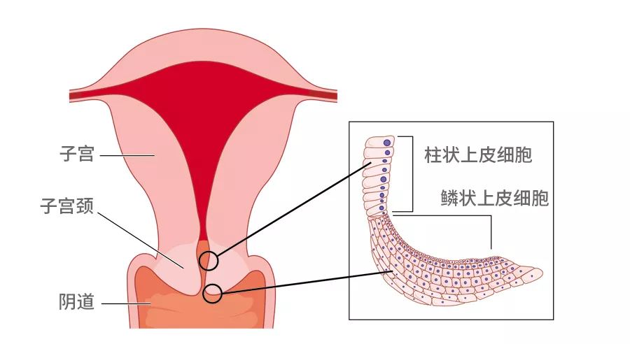 cn 正版图片库 简单说就是:宫颈里的细胞长到了宫颈口外,因为这些柱状